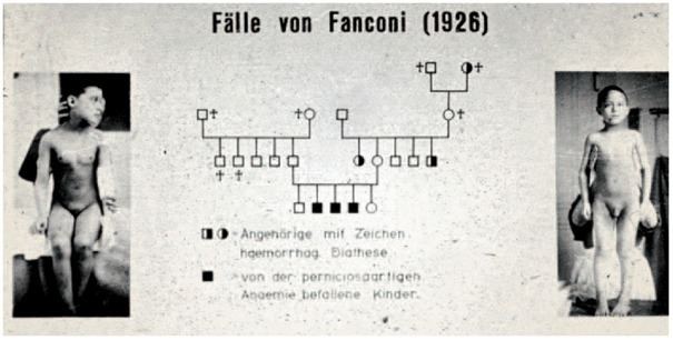 Guido Fanconi Original slide from a lecture by Guido Fanconi showing two of