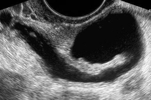 Gynecologic ultrasonography - Alchetron, the free social encyclopedia