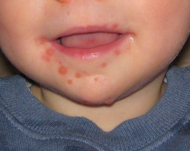 Hand, foot, and mouth disease