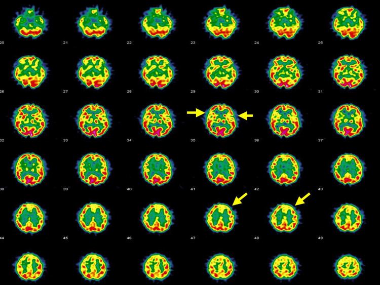 Hashimoto's encephalopathy