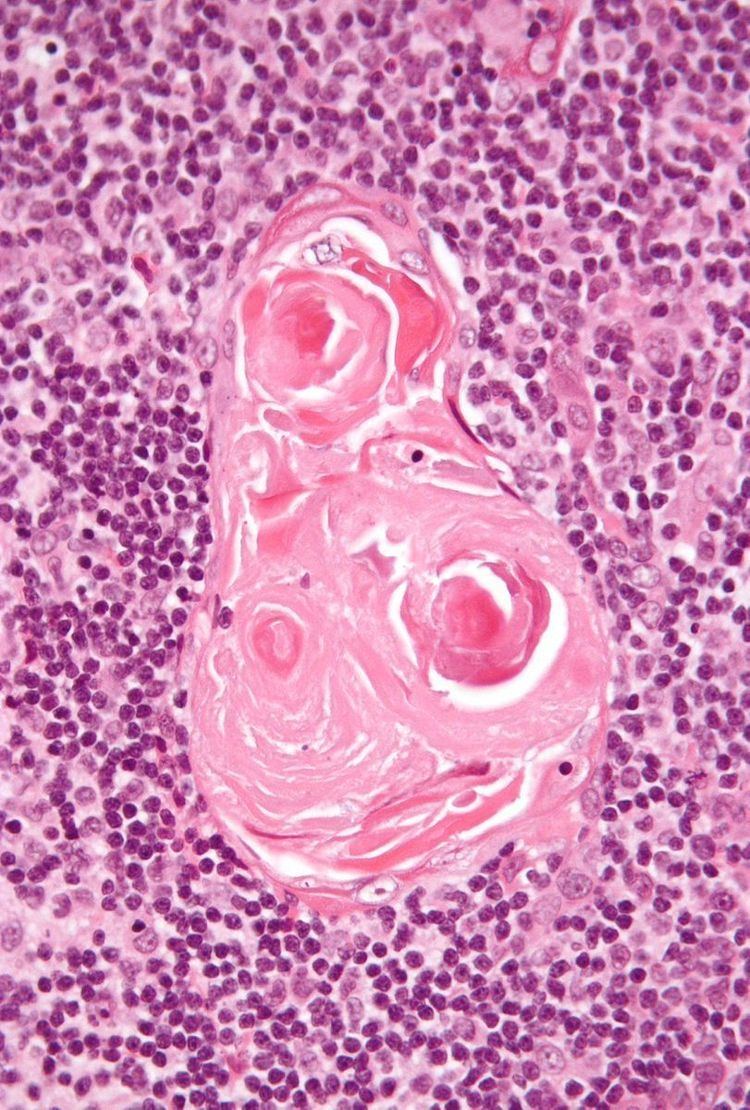 Hassall's corpuscles