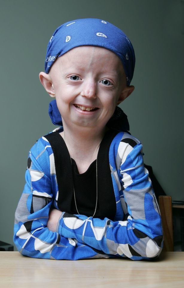Hayley Okines Progeria Hayley Okines Died Hayley Okins Pinterest Hayley okines