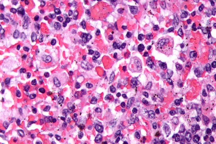 Hemophagocytic lymphohistiocytosis