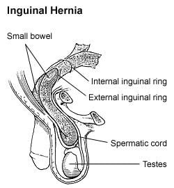 Healing Inguinal Hernia With Exercise Full Workout Youtube