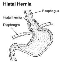 Hiatus hernia