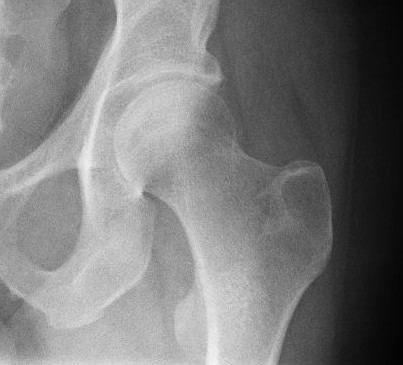 Hip fracture