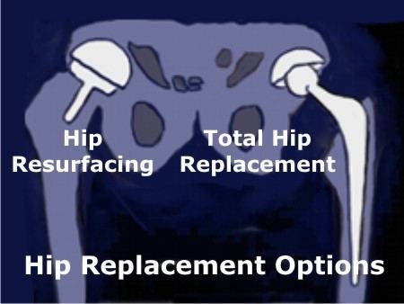 Hip resurfacing