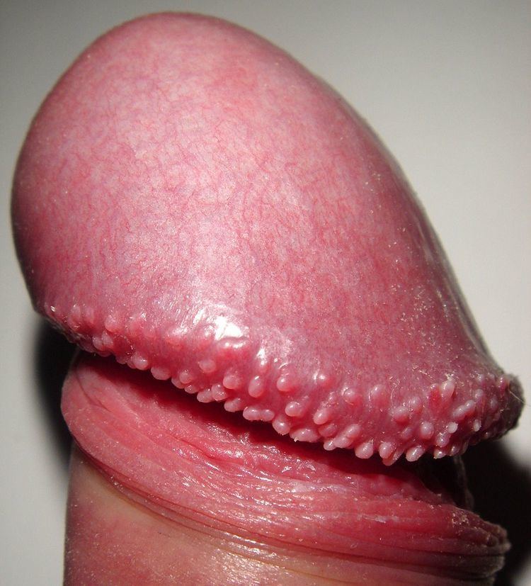 and pearly penile papules) are small protuberances that may form on the rid...