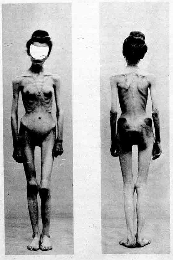 History of anorexia nervosa