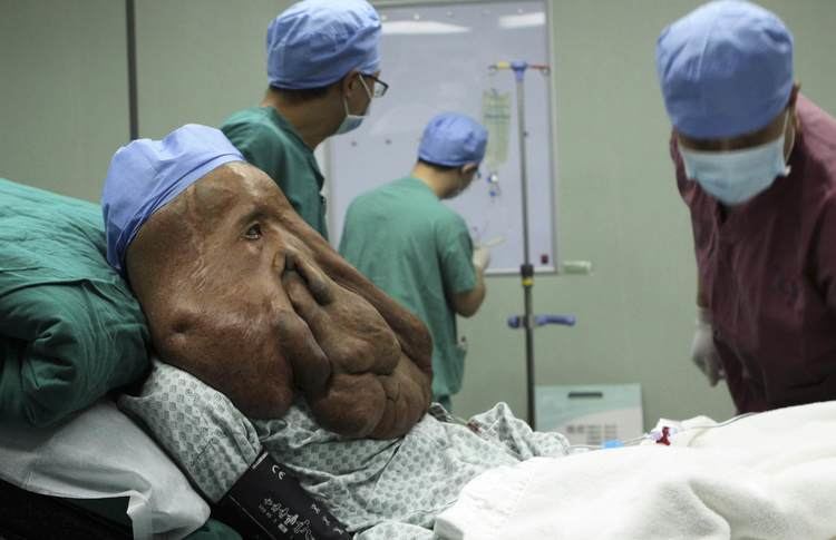 Huang Chuncai has a large and deformed face wearing a patient's uniform and a blue surgical cap, lying in the hospital bed with a green and white pillow on his back with a white blanket inside the surgery room along with three doctors in scrubs suits and surgical cap. The two doctors on his side wearing green scrub suits and maroon scrub suits on the other doctor facing him.
