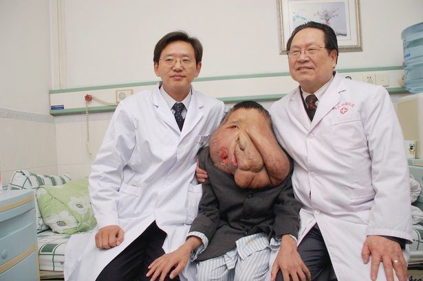 Huang Chuncai has a large and deformed face, smiling, sitting in between two doctors in a hospital bed and resting his hands on the doctors' laps, and wearing a patient's cloth under a gray coat