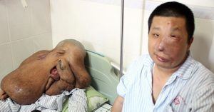 Huang Chuncai and his brother Huang Weicai (right). Chuncai has a large and deformed face, lying in a hospital bed, and wearing a patient's uniform with  Weicai sitting beside his bed, in the same condition as his brother, he is wearing a patient's uniform