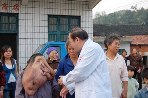 Huang Chuncai has a large and deformed face wearing gray long sleeves, shaking hands with one of the doctors and who performed the operation on him with people in his hometown in the background, wearing eyeglasses, a white laboratory gown