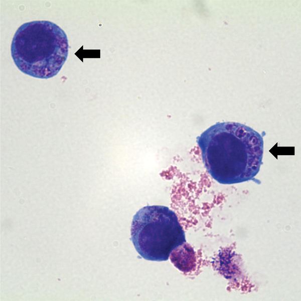 Human granulocytic anaplasmosis