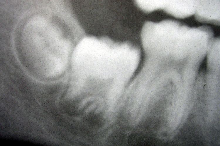 Human tooth development