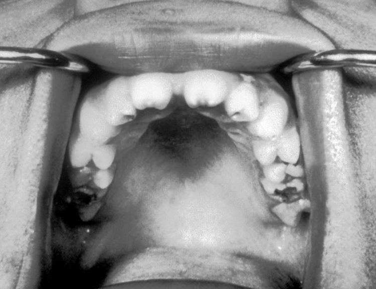 Hutchinson's teeth