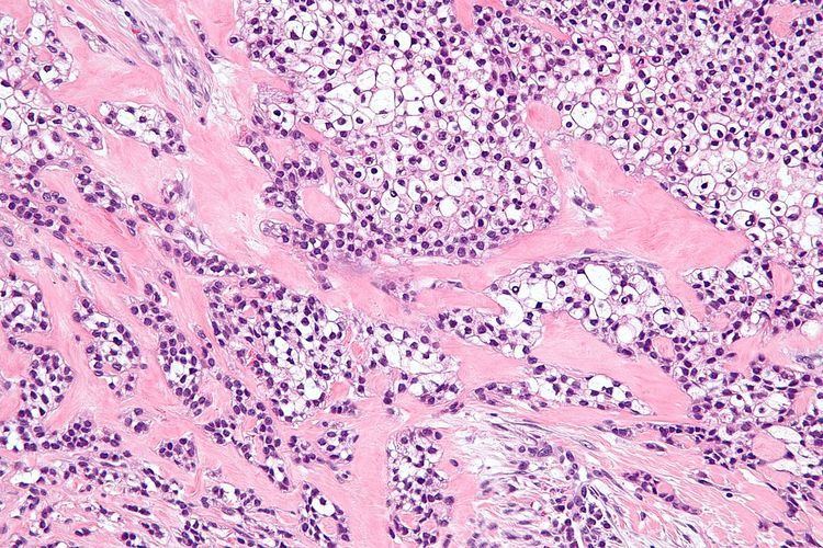 Hyalinizing clear cell carcinoma