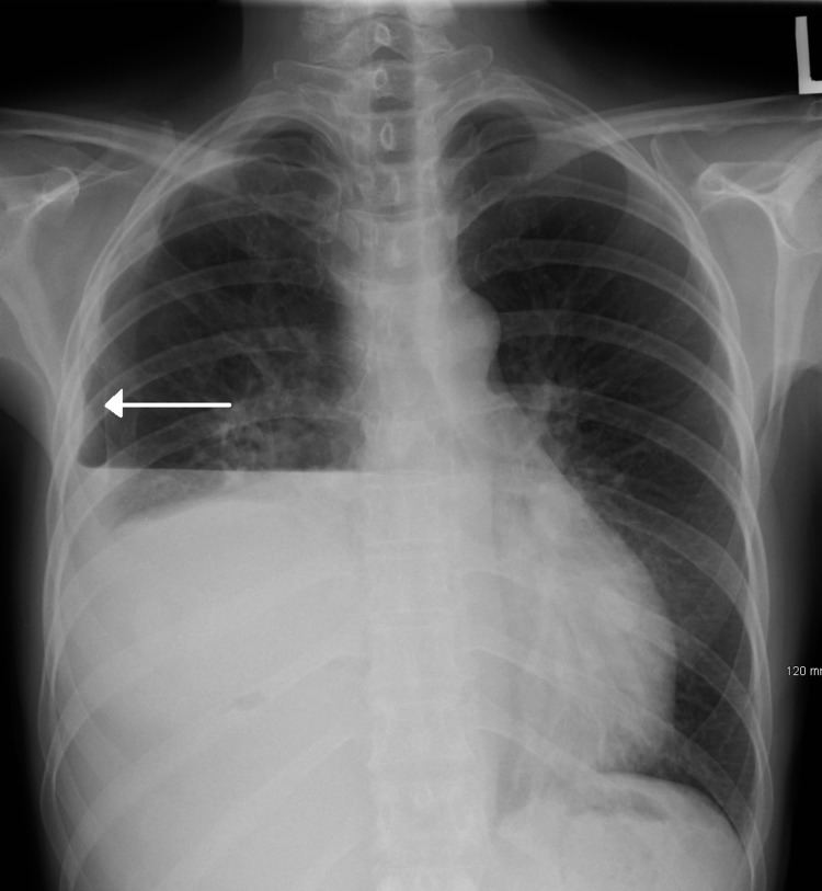 Hydropneumothorax - Alchetron, The Free Social Encyclopedia