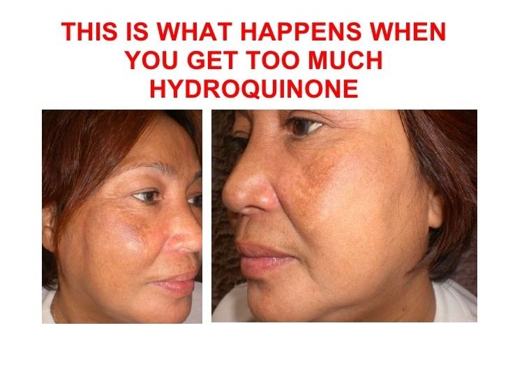 Hydroquinone Dangers Of Hydroquinone