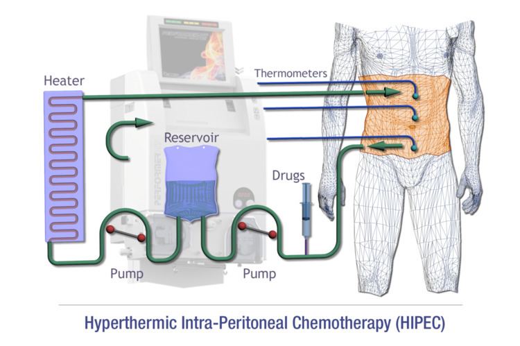 Hyperthermic intraperitoneal chemotherapy