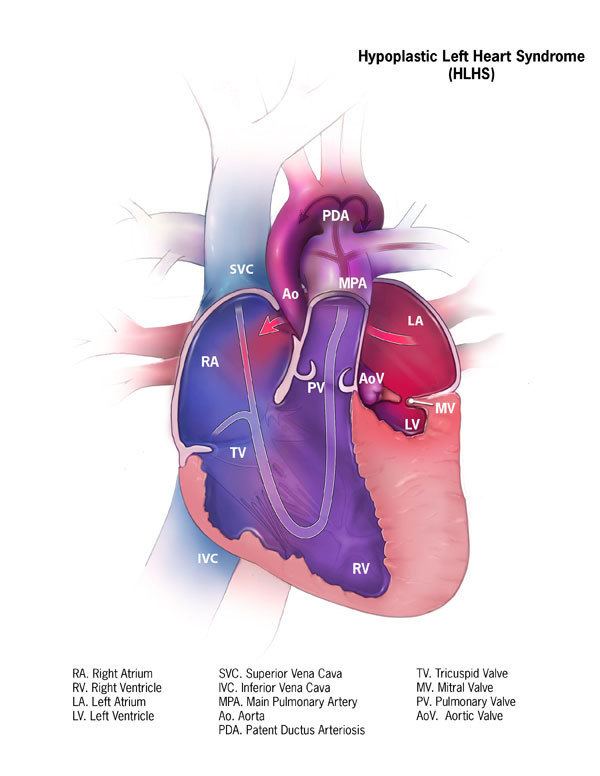 Hypoplastic left heart syndrome - Alchetron, the free social encyclopedia