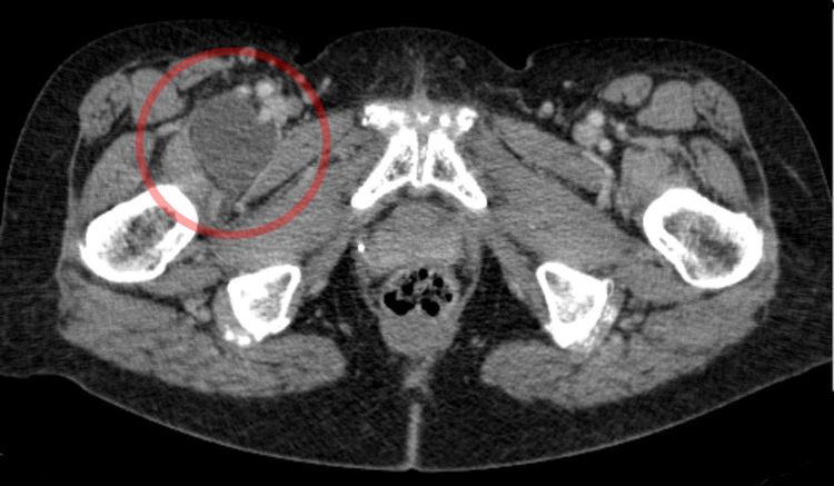 Iliopectineal bursa