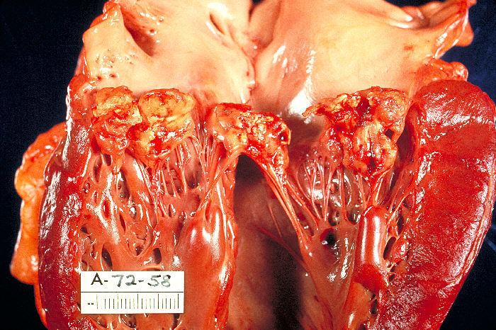 Infective endocarditis