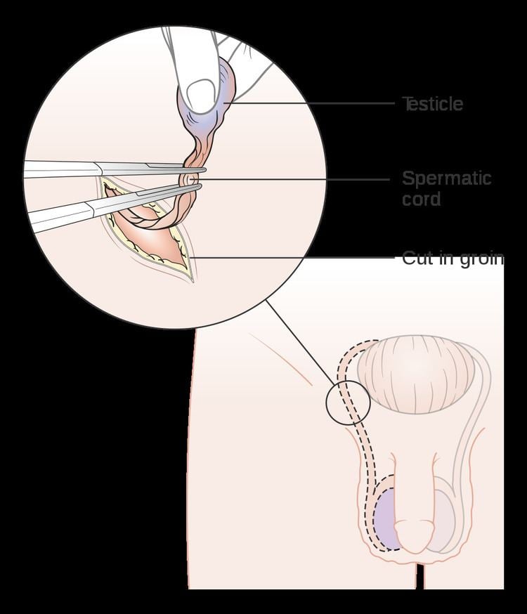 Inguinal orchiectomy