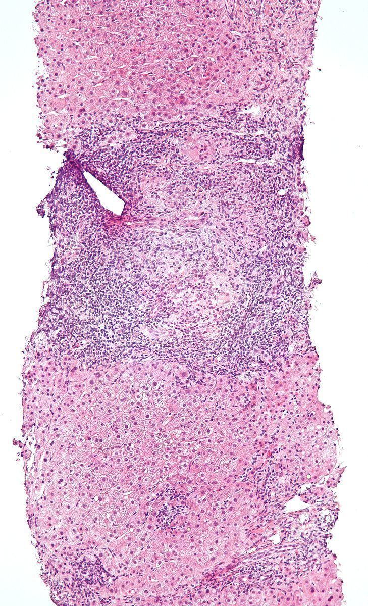 Intraepithelial lymphocyte