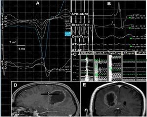 Intraoperative neurophysiological monitoring Intraoperative Neurophysiology Monitoring Unit IONM