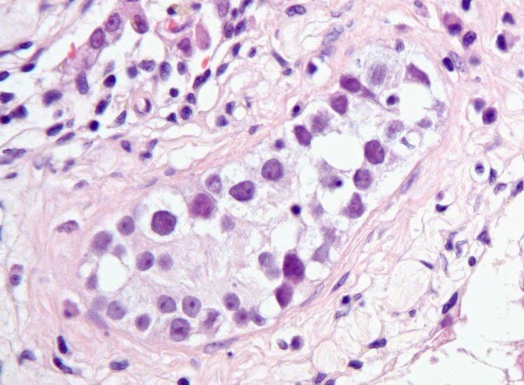 Intratubular germ cell neoplasia