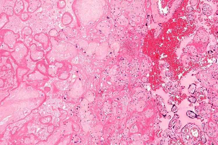 Intrauterine hypoxia