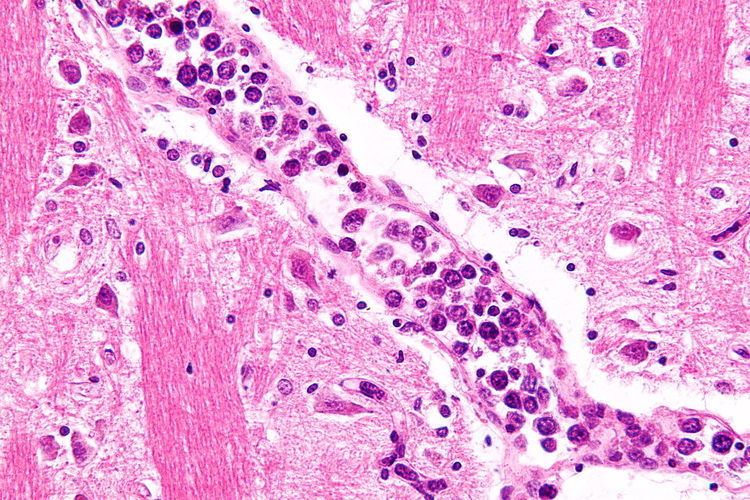 Intravascular large B-cell lymphoma