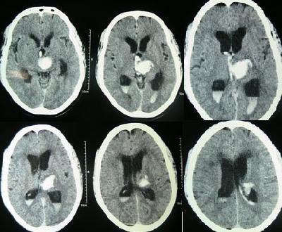 Intraventricular hemorrhage