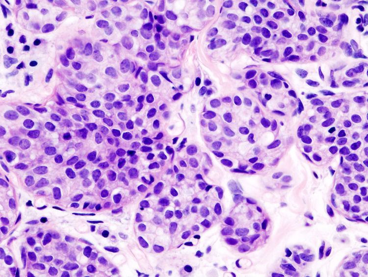 invasive lobular carcinoma grade 2 icd 10