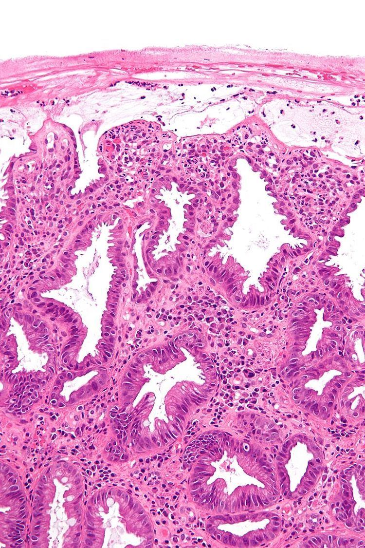 Ischemic colitis