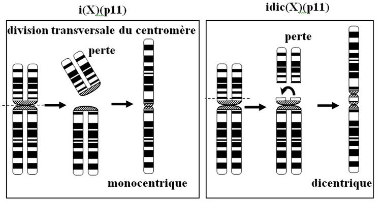 Monocentric Isochromosome on the left side and dicentric Isochromosome on the right side
