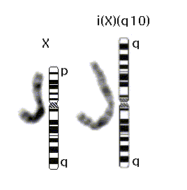 Final diagnosis of a variant turner syndrome