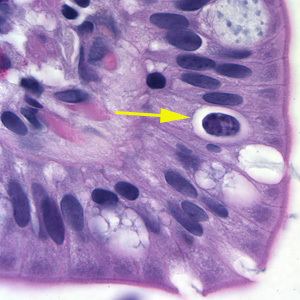 Isosporiasis