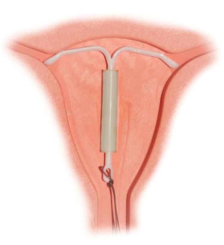 IUD with progestogen