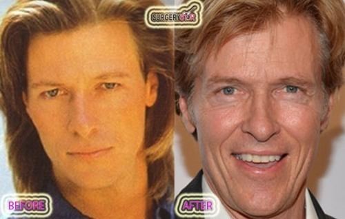 Jack Wagner (actor) Jack Wagner Surgery Plastic Surgery Index
