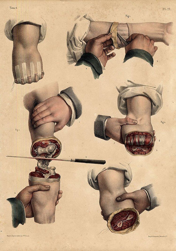 Jean-Baptiste Marc Bourgery 2 Antique Medical Anatomy PrintsAMPUTATIONARMJOINTPl