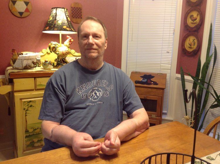 Jeff Kepner Double Hand Transplant Recipient Wants Them Removed Timecom