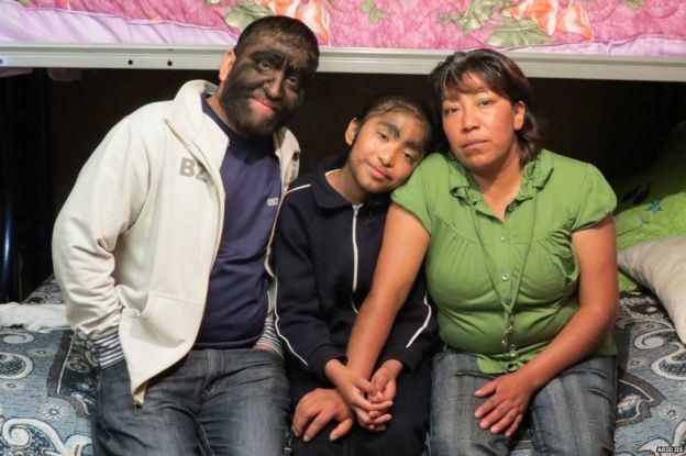 Jesús Aceves The struggles of the worlds hairiest family BBC News
