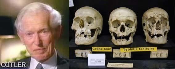 John Charles Cutler LEFT Dr John Charles Cutler RIGHT The deformed skulls of those