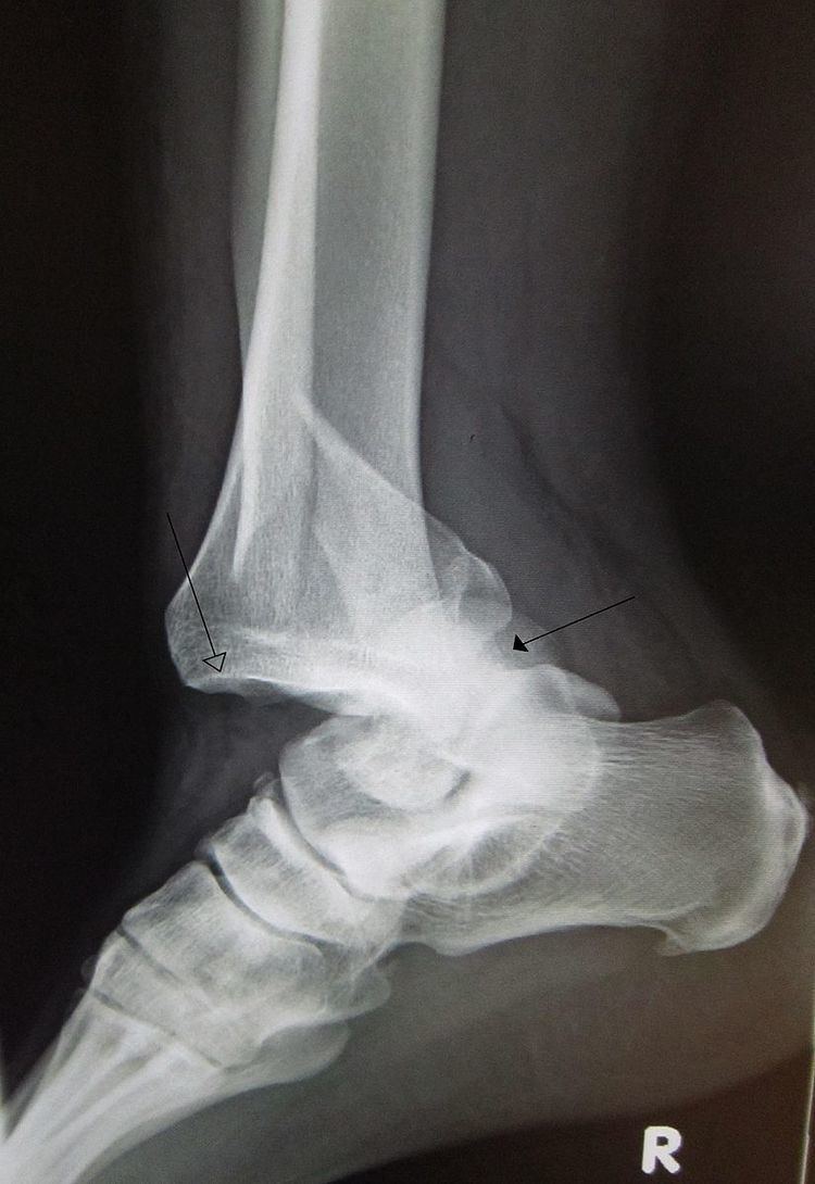 Joint dislocation