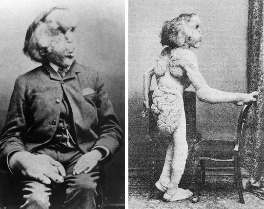 Joseph Merrick Reexamining 39the Elephant Man39 The Public Domain Review