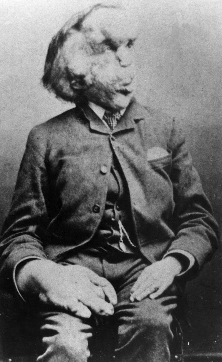 Joseph Merrick Joseph Merrick Wikipedia the free encyclopedia