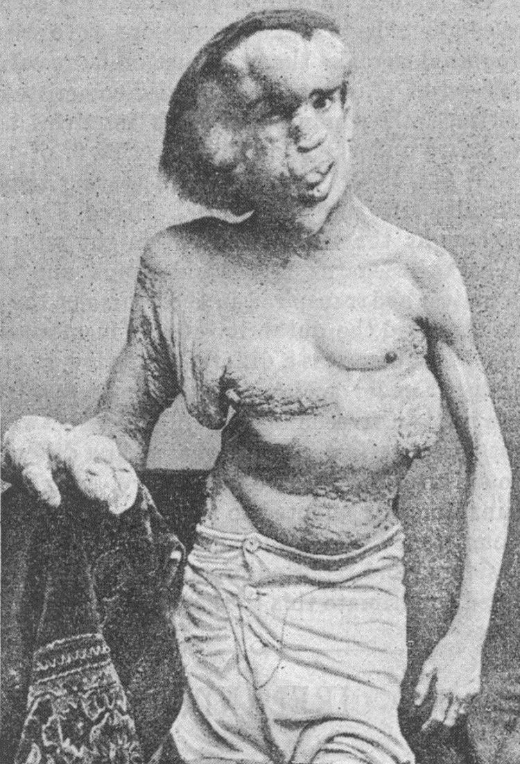 Joseph Merrick The Johnny Green Joseph Merrick The Elephant Man