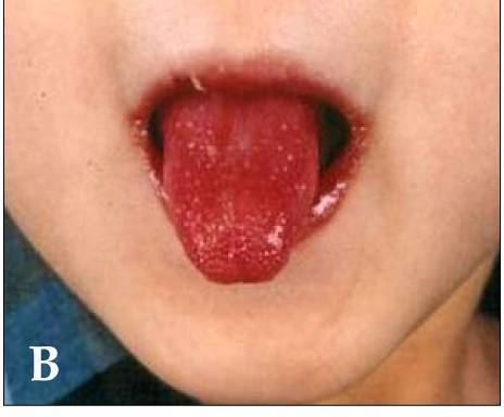 Kawasaki disease